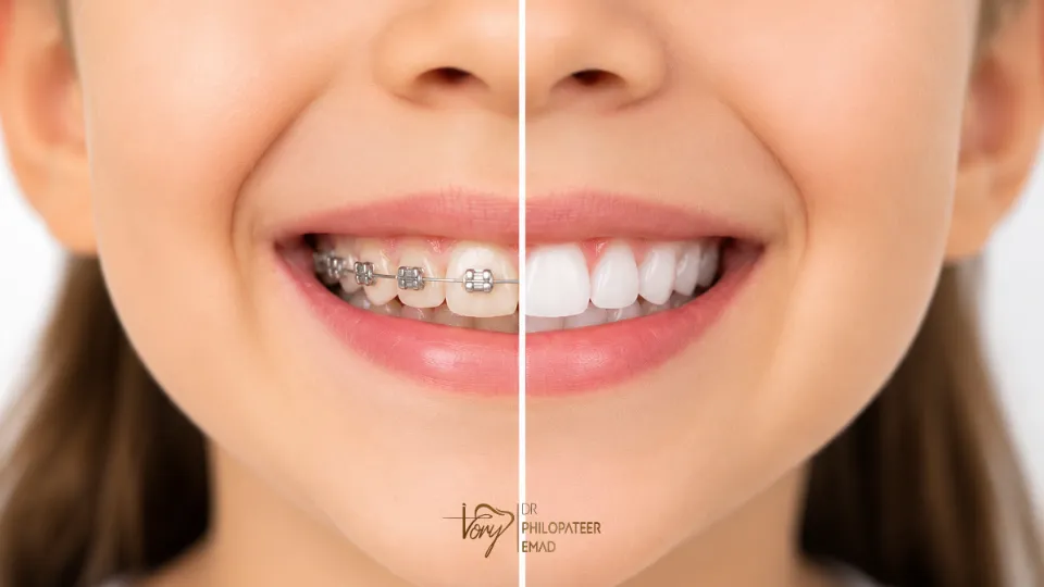 How to Get Teeth White After Braces How to Get Teeth White After Braces