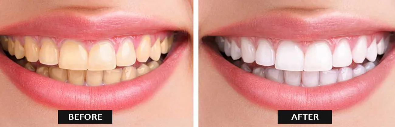 Is Laser Teeth Whitening Permanent Is Laser Teeth Whitening Permanent