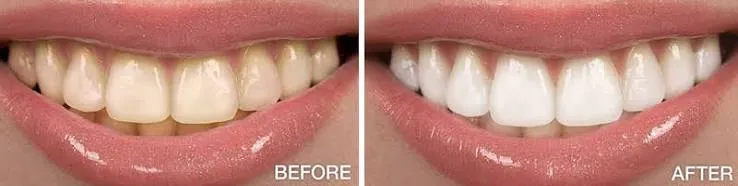 Teeth Whitening for Brides Teeth Whitening for Brides
