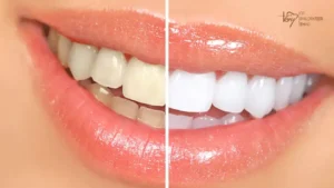 how does teeth whitening work